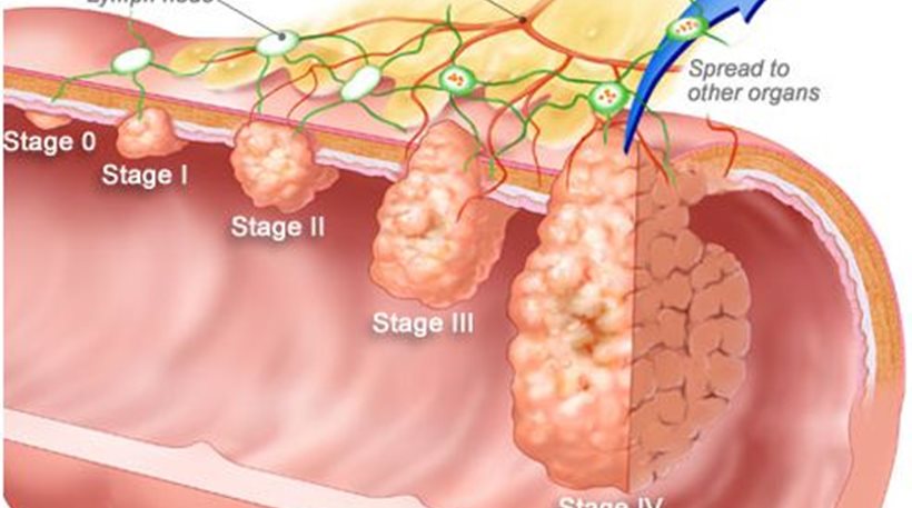 Πάνω από 5.000 Έλληνες εκδηλώνουν κάθε χρόνο καρκίνο του παχέως εντέρου